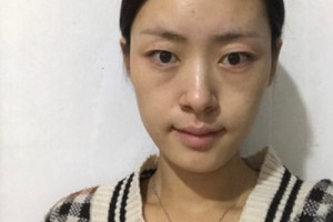 洛陽華美整形美容醫(yī)院怎么樣？激光去皺好不好？