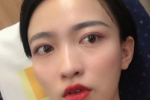 惠州中心醫(yī)院整形美容祛斑果？術(shù)后注意事項(xiàng)必看
