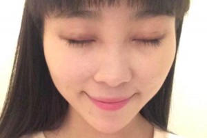 臨沂市人民醫(yī)院雙眼皮怎么樣？注意事項+術前準備必看