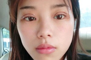 長沙亞韓整形醫(yī)院雙眼皮價格？術后幾點需注意！