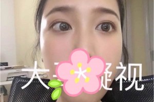 成都西嬋整形醫(yī)院雙眼皮術(shù)后恢復(fù)記錄！快看