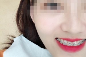 青島優(yōu)諾博士口腔醫(yī)院牙齒矯正怎么樣？恢復(fù)圖分享