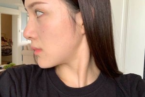 廈門第一醫(yī)院美容科下頜角怎么樣？術前術后對比圖！