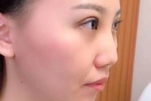 廈門第一醫(yī)院整形科哪位醫(yī)生好？埋線雙眼皮術后果&價格表