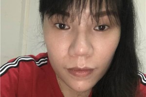 無(wú)錫人民醫(yī)院膨體隆鼻怎么樣？真實(shí)案例分享！