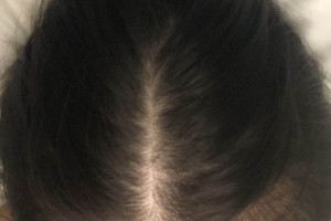 杭州新生毛發(fā)醫(yī)院種植頭發(fā)果如何？附案例圖測評！