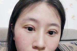 南昌大學(xué)美容醫(yī)院切開雙眼皮是正規(guī)嗎？附果圖&價格表
