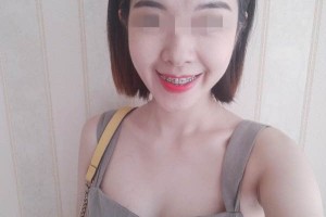 南京口腔醫(yī)院牙齒矯正哪個(gè)醫(yī)生好/真實(shí)案例對(duì)比！