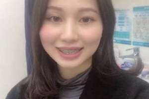 濟(jì)南圣貝口腔醫(yī)院牙齒矯正怎么樣/真實(shí)案例對(duì)比！