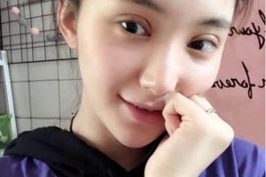 上海千美醫(yī)療美容院定點(diǎn)雙眼皮？術(shù)后術(shù)前明X果～