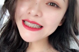 重慶美奧口腔醫(yī)院怎么樣？附醫(yī)院信息+正畸果圖