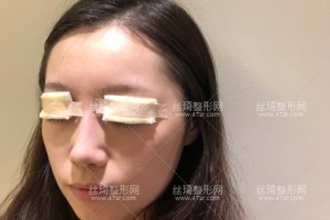 上海九院雙眼皮哪個(gè)醫(yī)生做的好？附雙眼皮案例圖+價(jià)格表